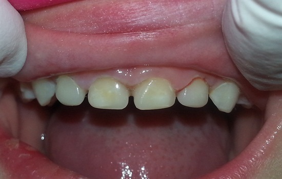 Lire la suite de l'article Dentisterie héroïque : Des couronnes à nu pour Leigh