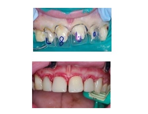 Lire la suite de l'article La dentisterie héroïque : Autisme sévère, caries rampantes et couronnes en bandes