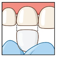 Couronne de bandes Figure 3
