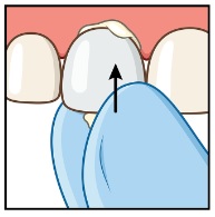Couronne de bandes Figure 5