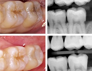 Lire la suite de l'article Dentisterie héroïque : La technique du sandwich ouvert