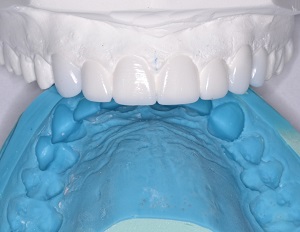 Lire la suite de l'article Dentisterie héroïque : Sauvetage compassionnel du sourire avec ACTIVA BioACTIVE-RESTORATIVE