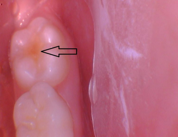 Lire la suite de l'article Directement de la salle d’opération : Embrace Pit & Fissure Sealant