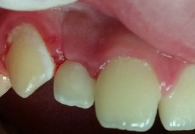 Lire la suite de l'article En direct de la salle d’opération : Remplissage en vrac avec ACTIVA BioACTIVE-RESTORATIVE