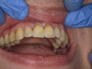 Lire la suite de l'article Dentisterie héroïque : Traumatisme, résorption externe, extraction et attelle de la couronne naturelle avec ACTIVA