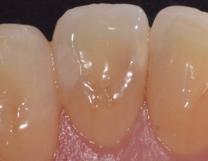 Lire la suite de l'article Utilisation de matériaux de restauration bioactifs chez les patients présentant un risque élevé de caries