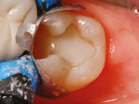 clinical-procedure-activa-baseliner-2