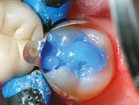 clinical-procedure-activa-baseliner-3
