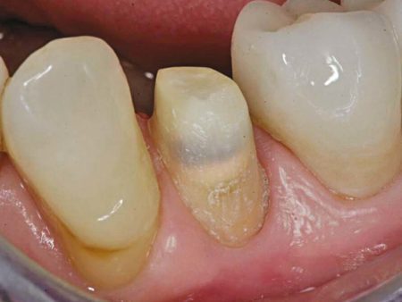 clinical-procedure-activa-cement-1
