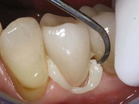 clinical-procedure-activa-cement-3