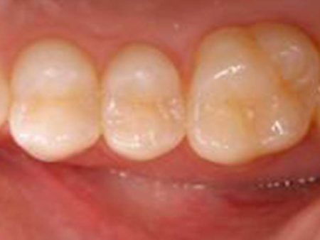 clinical-procedure-embrace-sealant-1