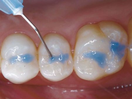 clinical-procedure-embrace-sealant-2