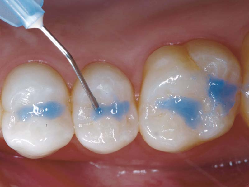 clinical-procedure-embrace-sealant-2