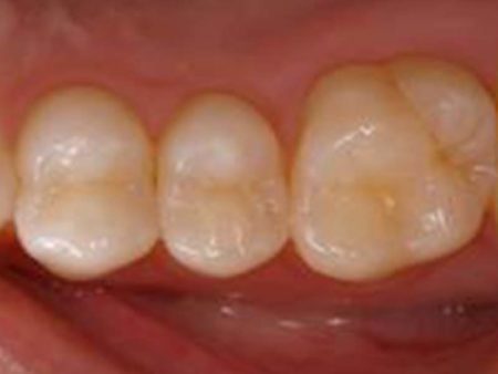 clinical-procedure-embrace-sealant-3