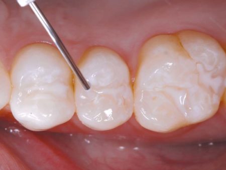 clinical-procedure-embrace-sealant-4