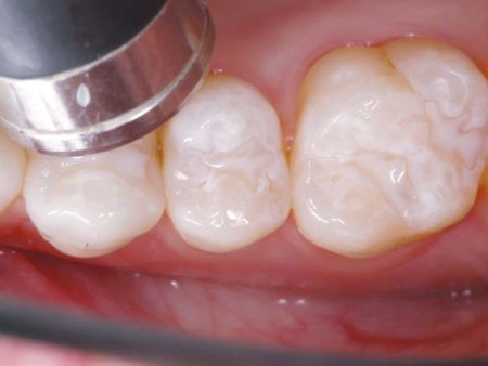 clinical-procedure-embrace-sealant-5