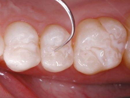 clinical-procedure-embrace-sealant-6