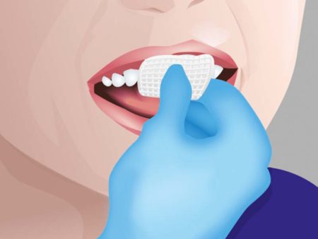 clinical-procedure-embrace-varnish-1