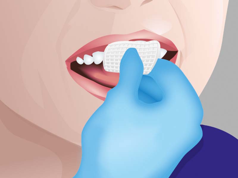 clinical-procedure-embrace-varnish-1