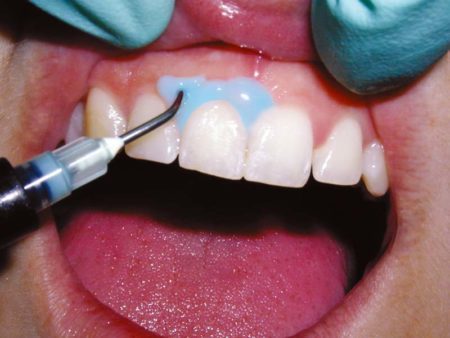 clinical-procedure-kool-dam-1