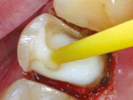clinical-procedure-spee-dee-3