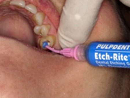 clinical-procedure1-embrace-ciment-2