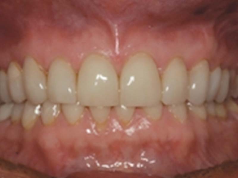 clinical-procedure1-kleer-veneer-1