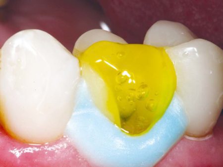 clinical-procedure2-porcelain-etch-gel-1