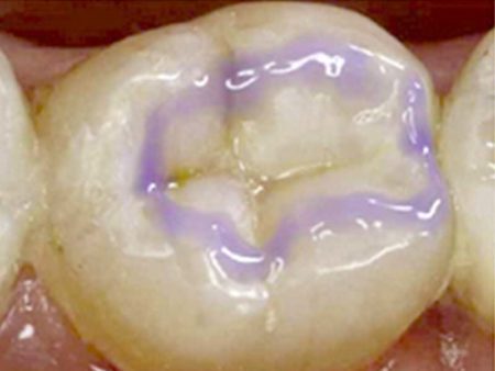 clinical-procedure2-seal-n-shine-1