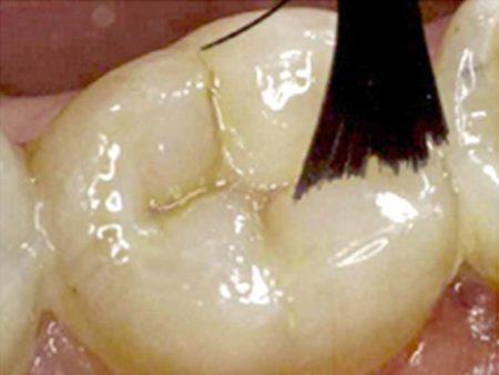 clinical-procedure2-seal-n-shine-2