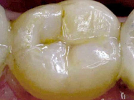 clinical-procedure2-seal-n-shine-3