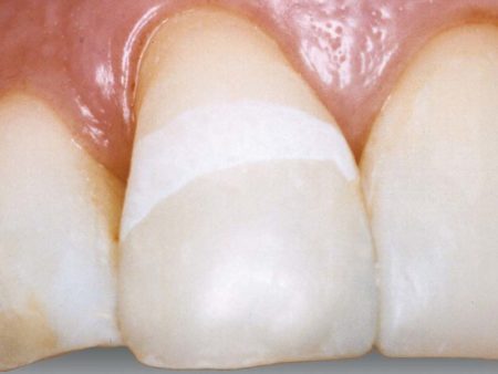 clinical-procedure3-seal-n-shine-1