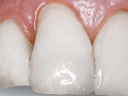 clinical-procedure3-seal-n-shine-2