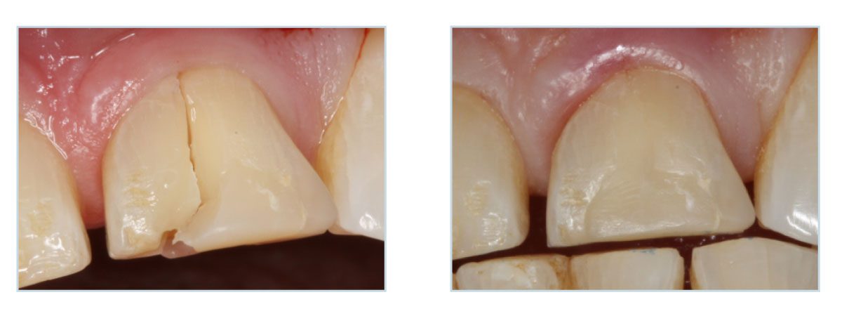 dent-fracturee-activa-presto