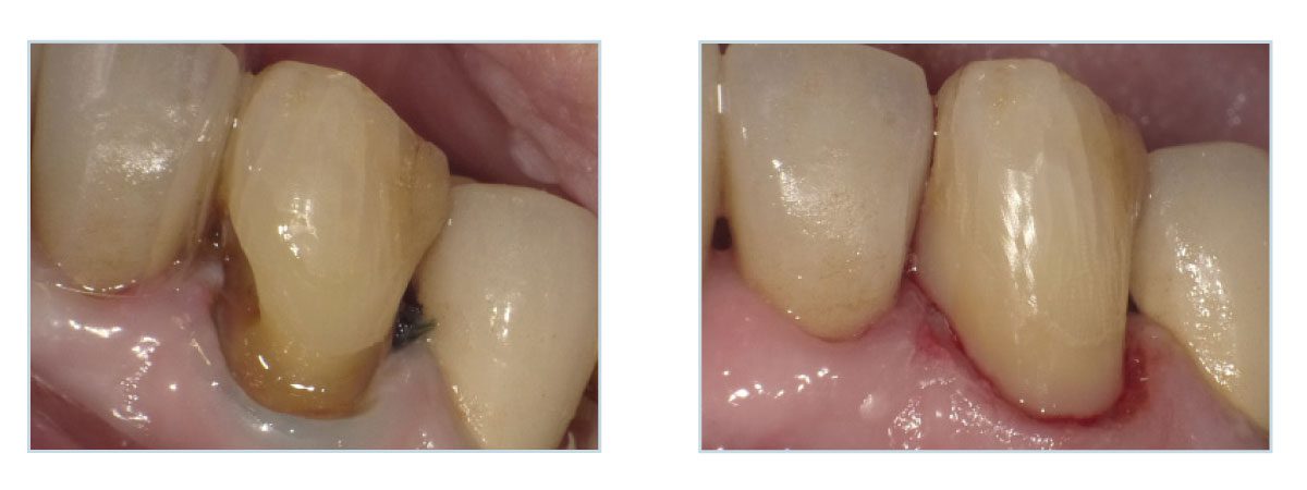 mesio-cervicale-activa-presto