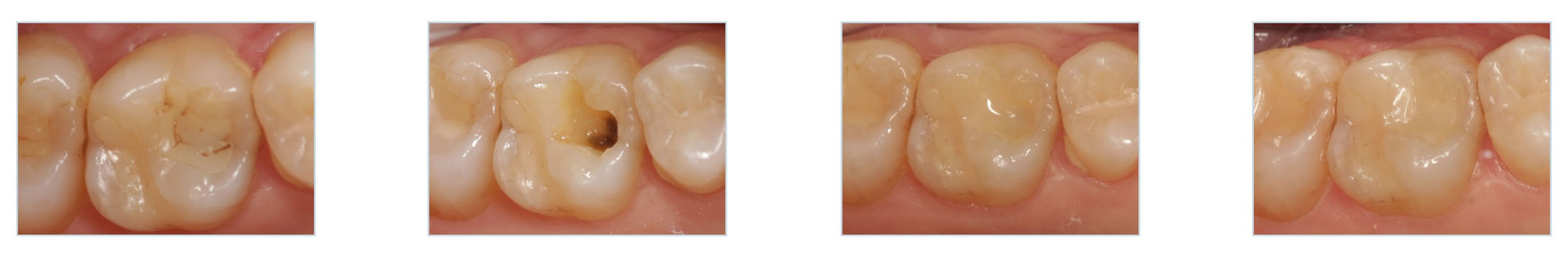 restauration-occlusale-activa-presto