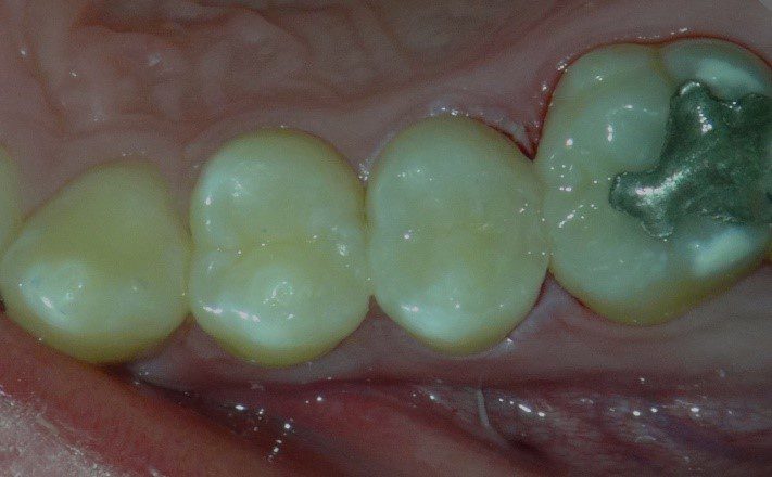 Lire la suite de l'article En direct de la salle d’opération : Restaurations bioactives mini-invasives
