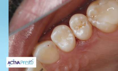 NOUVELLE VIDÉO ! Dr. Joshua Austin x Dental Economics présentent ACTIVA Presto