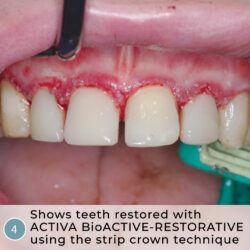 La dentisterie héroïque : Autisme sévère, caries rampantes, couronnes en bandes et ACTIVA BioACTIVE-RESTORATIVE