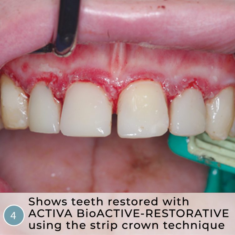 Lire la suite de l'article La dentisterie héroïque : Autisme sévère, caries rampantes, couronnes en bandes et ACTIVA BioACTIVE-RESTORATIVE