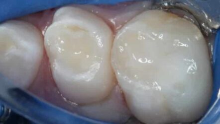 Restaurations bioactives en dentisterie pédiatrique