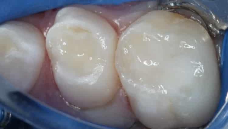 Lire la suite de l'article Restaurations bioactives en dentisterie pédiatrique