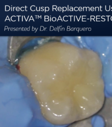 Remplacement direct de la cuspide à l’aide d’une restauration bioactive