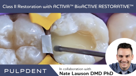 Restauration de classe II avec ACTIVA™ BioACTIVE-RESTORATIVE™